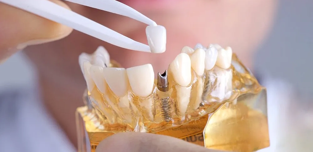 Exceptional Dental Implants