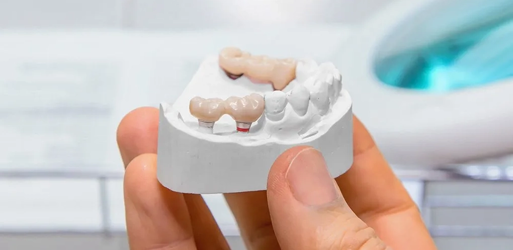 First-Rate Dental Bridges