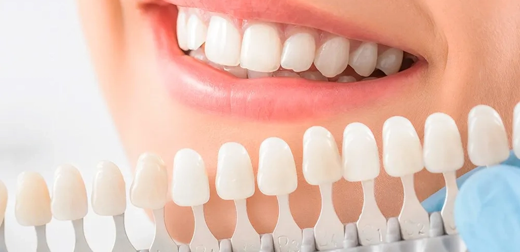 Incomparable Porcelain Veneers