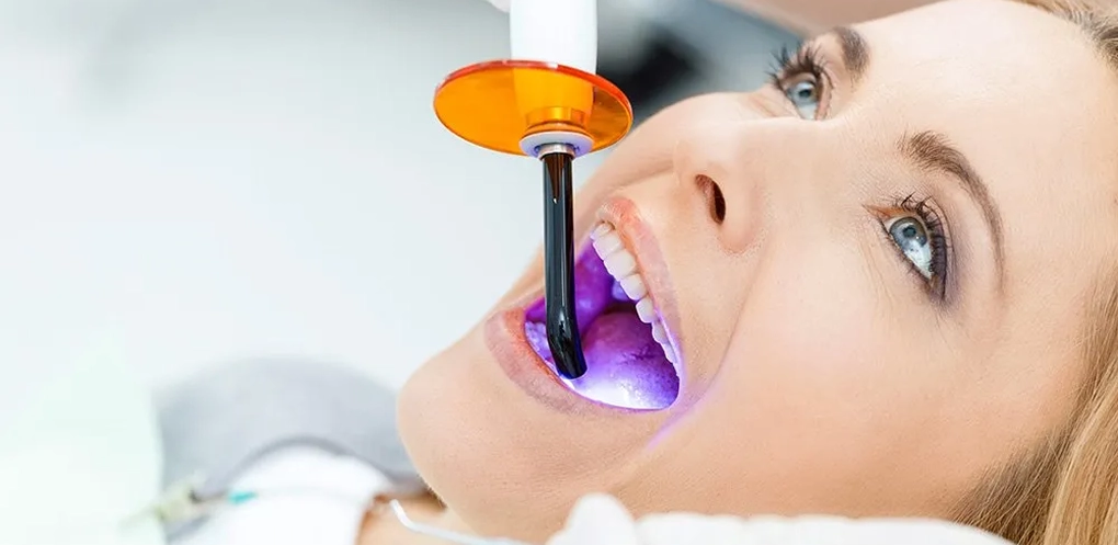 NATURAL TOOTH-COLORED COMPOSITE FILLINGS