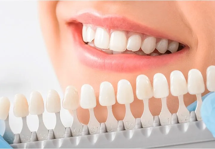 Porcelain Veneers & Ultra-Thin Vivaneers