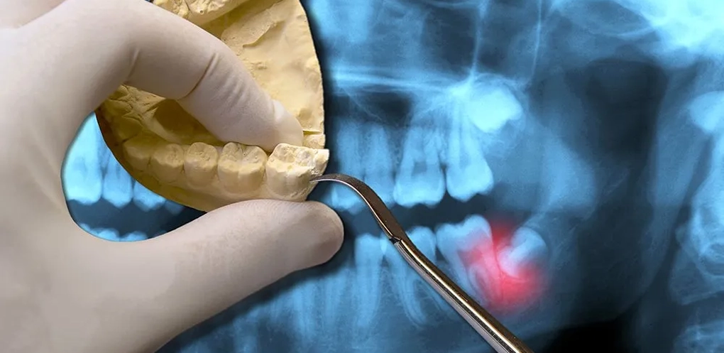Quick & Effective Tooth Extraction