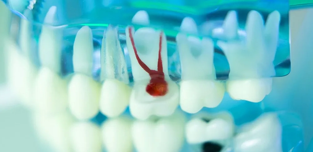 Root Canal (Endodontics)