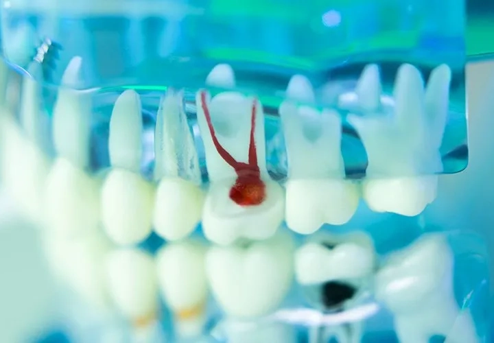Root Canals