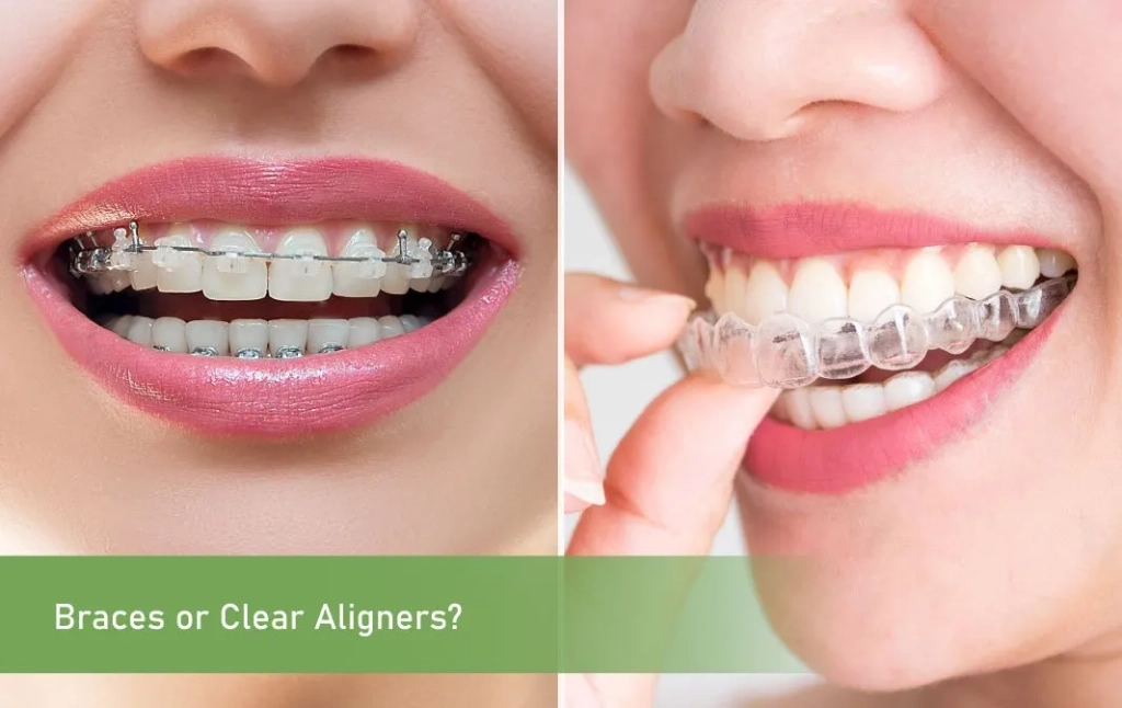 Braces or Clear Aligners