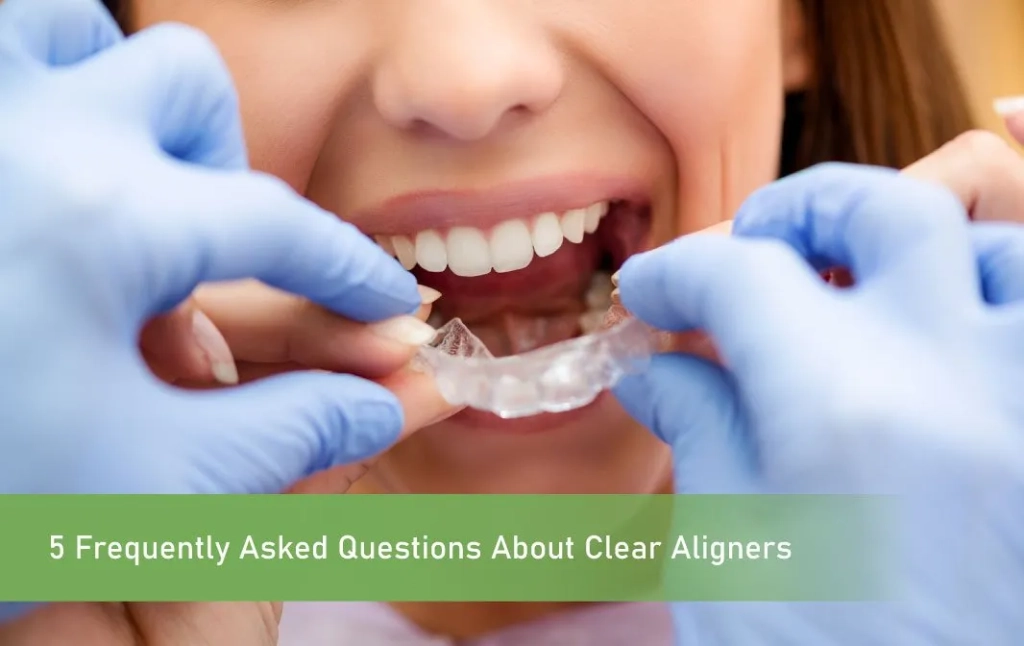 5 Frequently Asked Questions About Clear Aligners