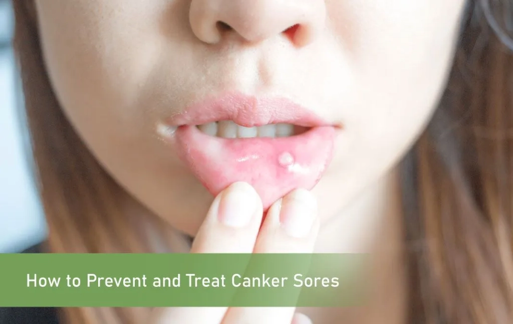 Prevent and Treat Canker Sores