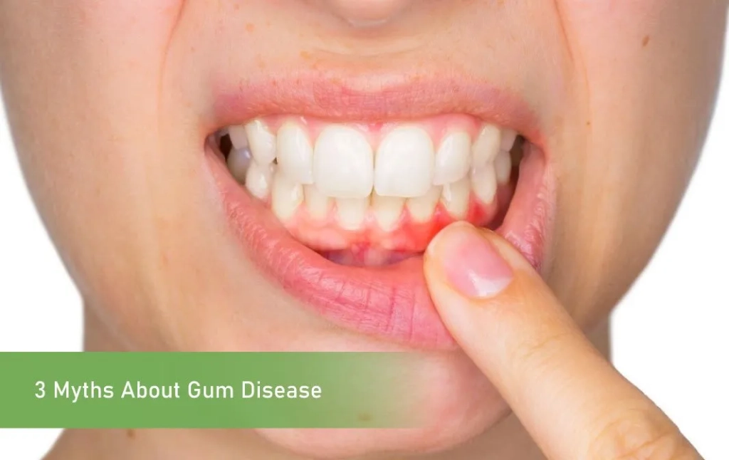 3 Myths About Gum Disease