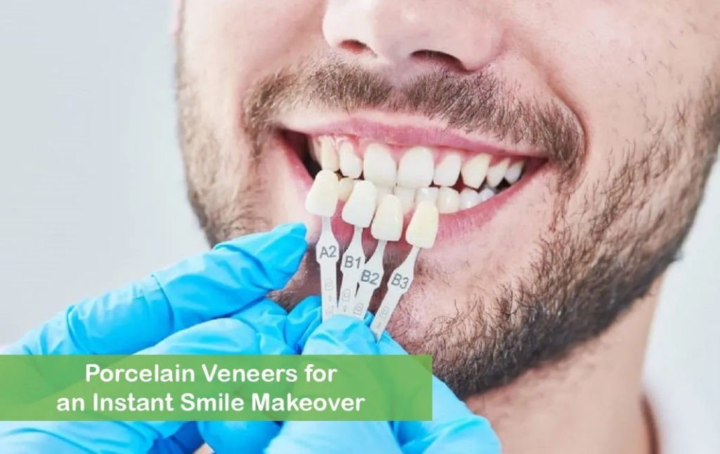 Porcelain Veneers for an Instant Smile Makeover
