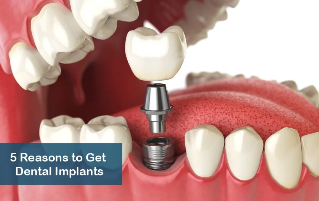 5 Reasons to Get Dental Implants