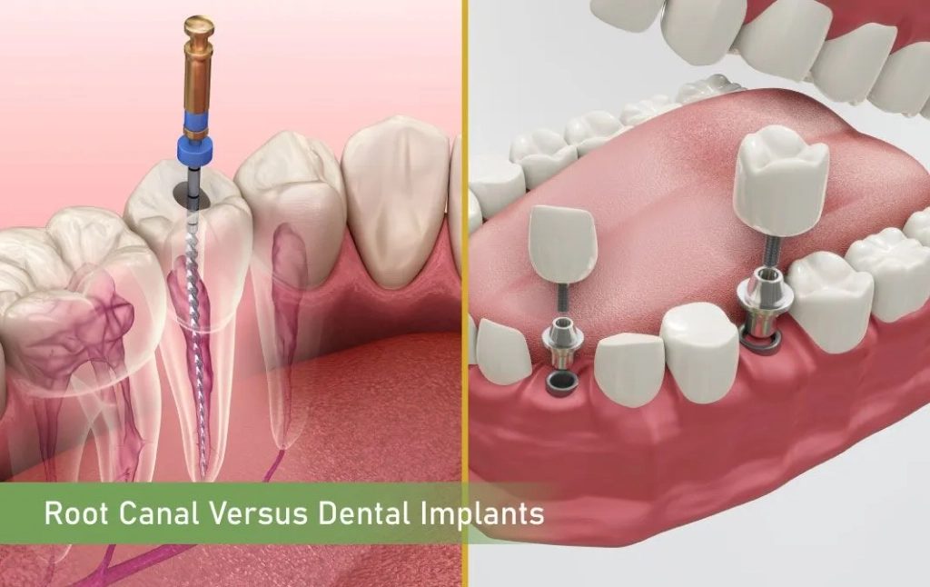 Root Canal Versus Dental Implants